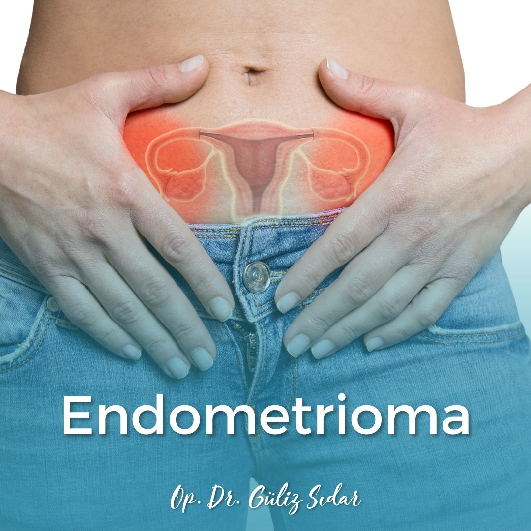 Endometrioma